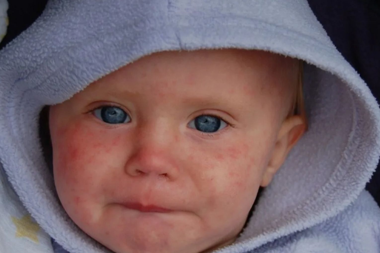 Australia has recorded more than 50 measles cases so far in 2025.