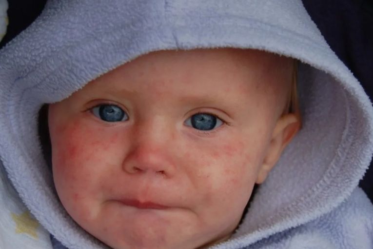 Thumbnail for We’re on the precipice of a measles disaster, experts say