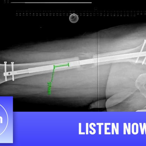 Thumbnail for Limb-lengthening surgery set for Australia