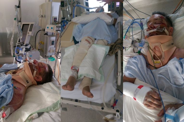 Thumbnail for ‘Hit by car’: One Nation MP on surviving two near-death cycling accidents