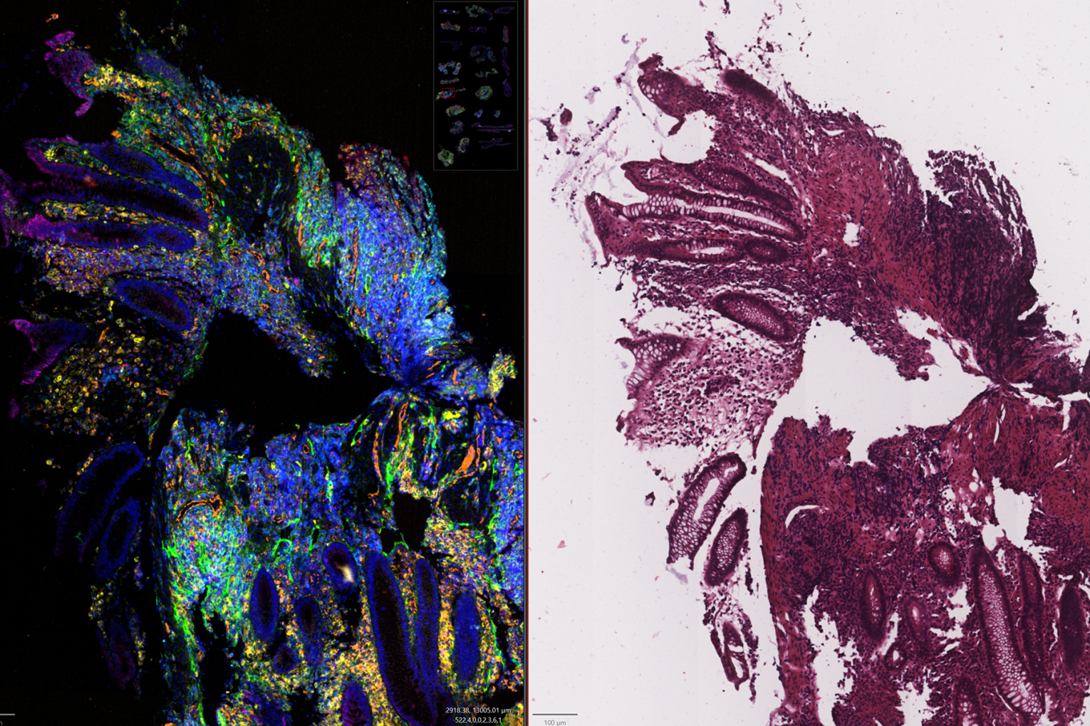 Tissue sample spatial analysis (on left) and standard H&E image (on right) - supplied QIMR Berghofer | Credit: QIMR Berghofer
